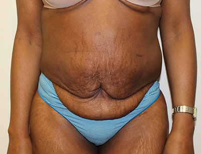 Tummy Tuck before and after - before