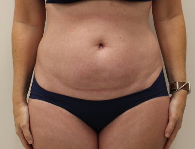 Tummy Tuck before and after - before