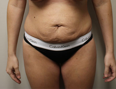 Tummy Tuck before and after - before