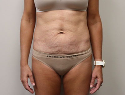 Tummy Tuck before and after - before