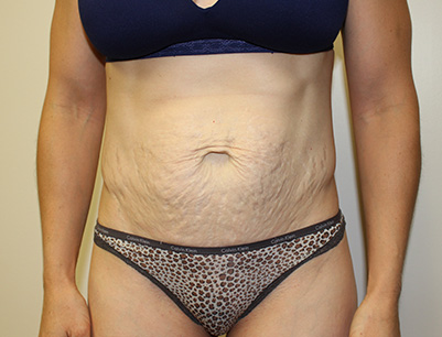 Tummy Tuck before and after - before
