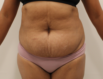 Tummy Tuck before and after - before