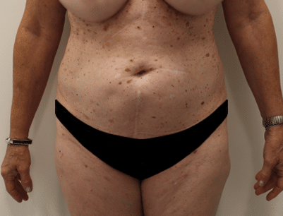 Liposuction before and after - before