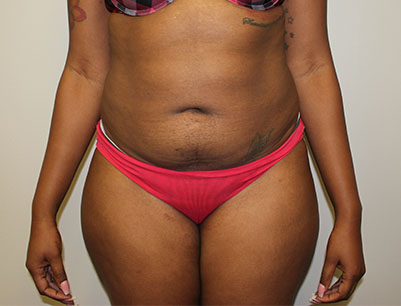 Liposuction before and after - before