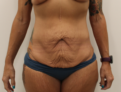 Tummy Tuck before and after - before