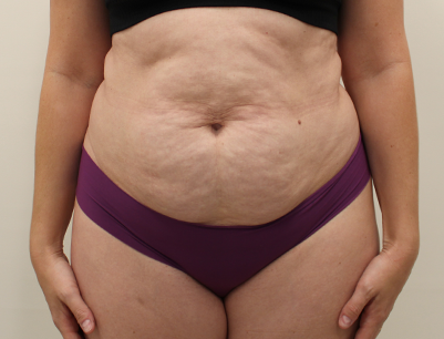 Tummy Tuck before and after - before