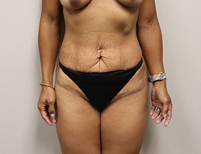 Tummy Tuck before and after - before