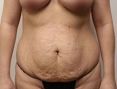 Tummy Tuck before and after - before