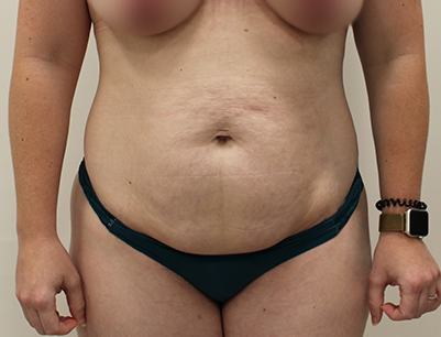 Tummy Tuck before and after - before