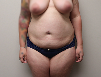 Tummy Tuck before and after - before
