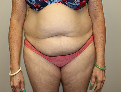 Tummy Tuck before and after - before