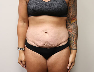 Tummy Tuck before and after - before