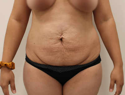 Tummy Tuck before and after - before