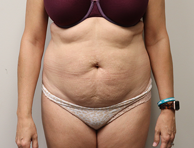 Tummy Tuck before and after - before