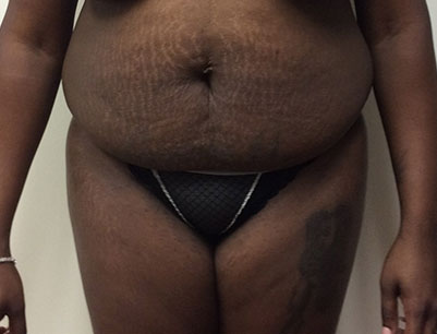 Tummy Tuck before and after - before