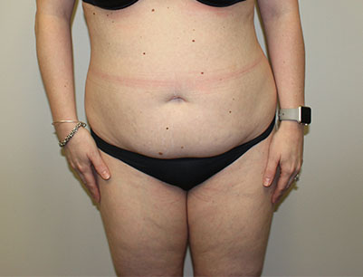 Tummy Tuck before and after - before