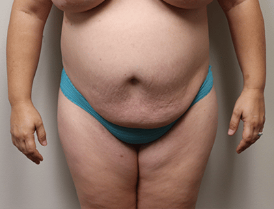 Tummy Tuck before and after - before