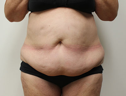 Tummy Tuck before and after - before