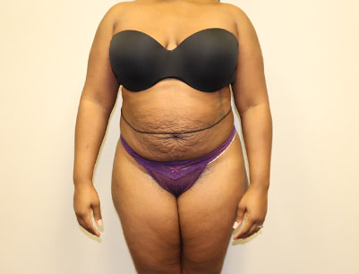 Tummy Tuck before and after - before