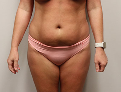 Liposuction before and after - before