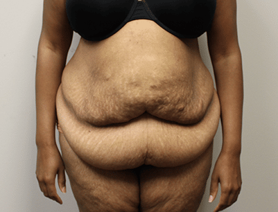 Tummy Tuck before and after - before