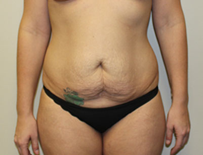 Tummy Tuck before and after - before