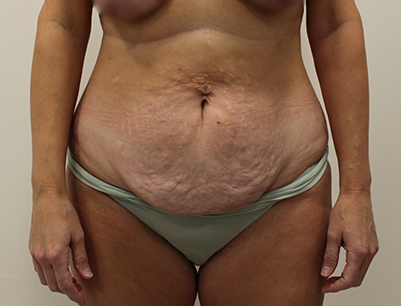 Tummy Tuck before and after - before