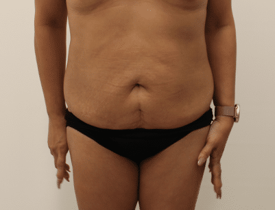 Tummy Tuck before and after - before