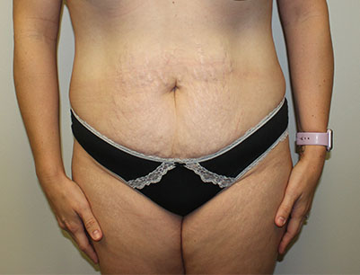 Tummy Tuck before and after - before