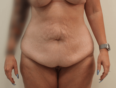 Tummy Tuck before and after - before