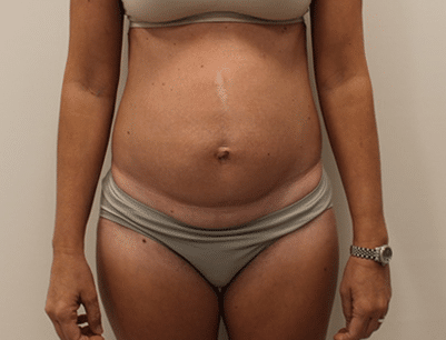 Tummy Tuck before and after - before