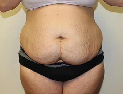 Tummy Tuck before and after - before