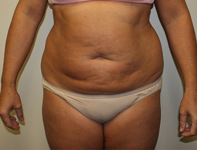 Liposuction before and after - before