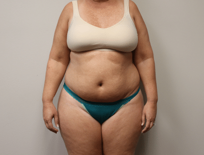 Liposuction before and after - before