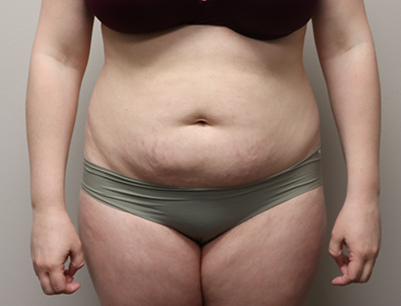 Tummy Tuck before and after - before