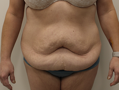 Tummy Tuck before and after - before