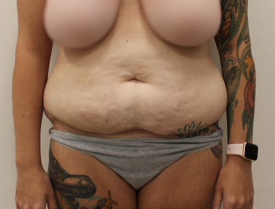 Tummy Tuck before and after - before