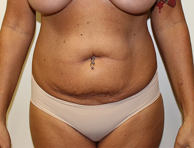 Tummy Tuck before and after - before