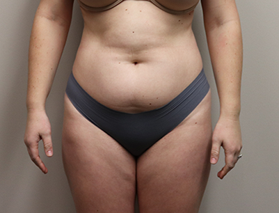 Liposuction before and after - before