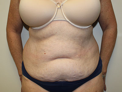 Tummy Tuck before and after - before