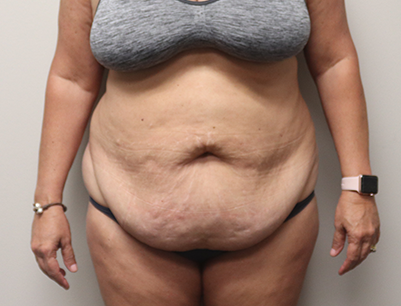 Tummy Tuck before and after - before
