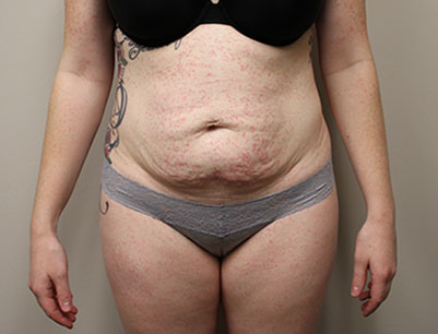 Tummy Tuck before and after - before