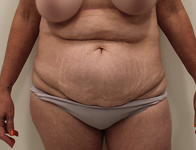 Tummy Tuck before and after - before
