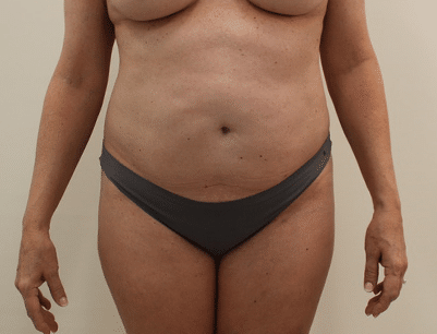 Tummy Tuck before and after - before
