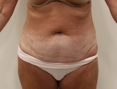 Tummy Tuck before and after - before