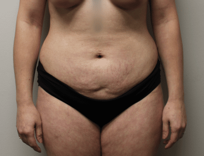 Tummy Tuck before and after - before