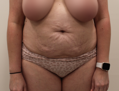 Tummy Tuck before and after - before