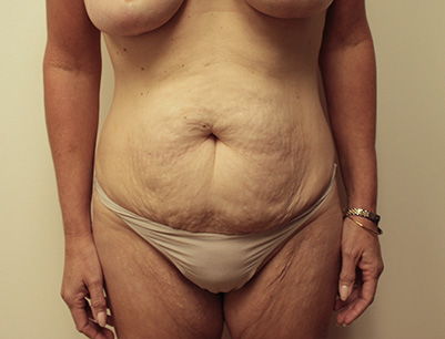 Tummy Tuck before and after - before