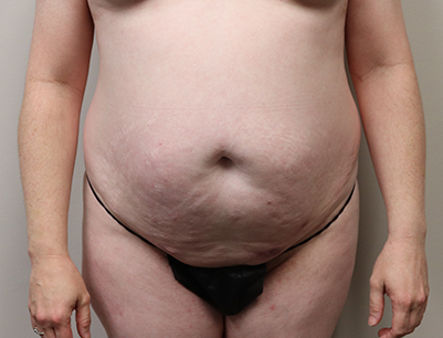 Tummy Tuck before and after - before