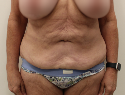 Tummy Tuck before and after - before